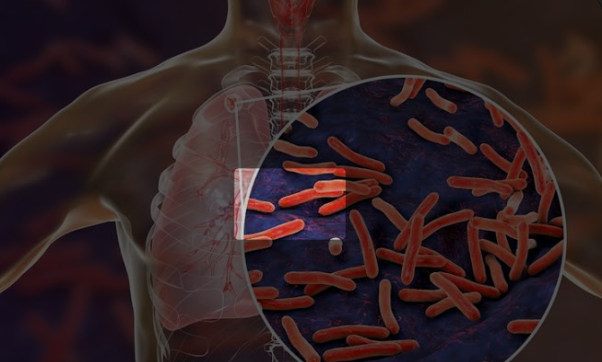 Waspada, WHO Laporkan Tuberkulosis/TBC Bunuh 1,23 Juta Orang pada 2024
