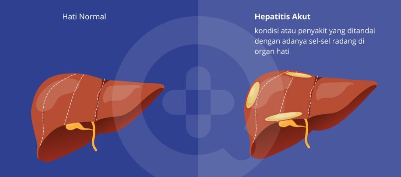 Ini Alasan Mengapa Kasus Hepatitis Akut Disebut Misterius