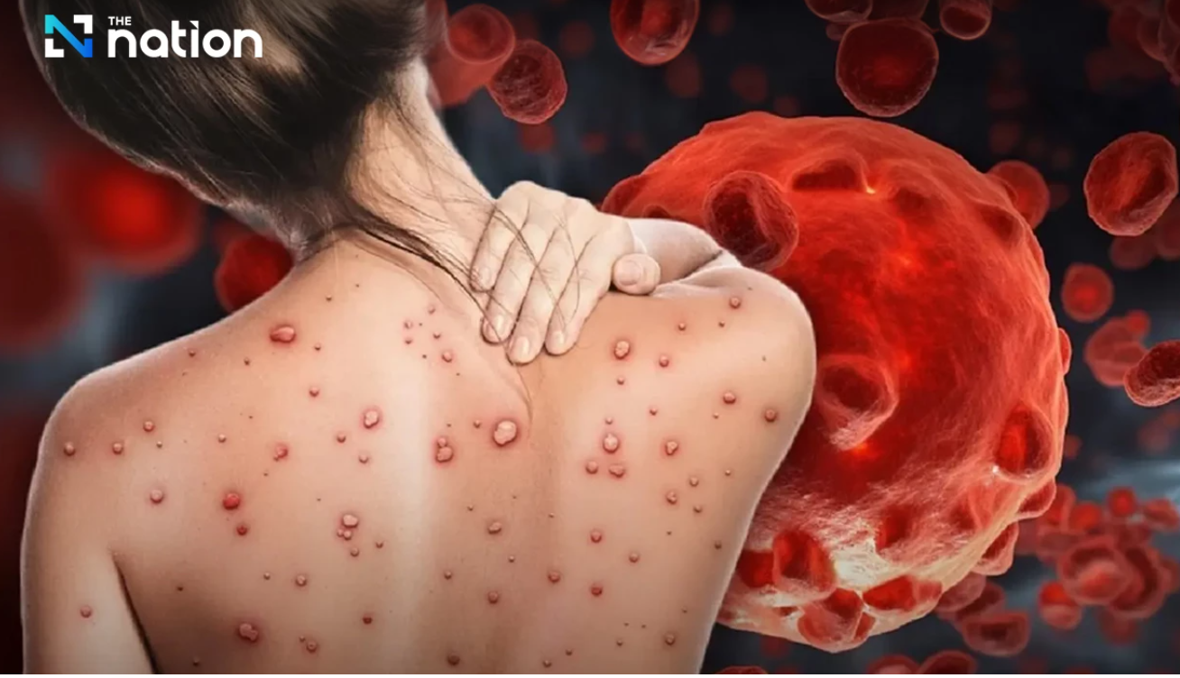 8 Subvarian Cacar Monyet di Thailand hanya Sebabkan Penyakit Ringan